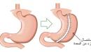 صورة مقال أضرار عملية تكميم المعدة