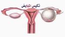 صورة مقال تكيس المبايض والحمل