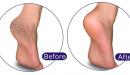 صورة مقال كيفية إزالة الجلد الميت من القدمين
