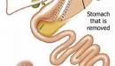 صورة مقال عملية تكميم المعدة
