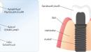 صورة مقال مراحل زراعة الأسنان
