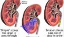 صورة مقال ما هو تضخم الكلى