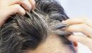 صورة مقال ظهور الشعر الأبيض للشباب
