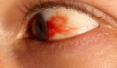 صورة مقال ظهور بقع دم في العين