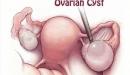 صورة مقال ما هو مرض تكيس المبايض