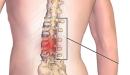 صورة مقال أعراض الانزلاق الغضروفي أسفل الظهر