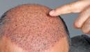 صورة مقال ما حكم زراعة الشعر