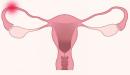 صورة مقال أسباب انسداد قناة فالوب