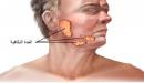 صورة مقال التهاب الغدة النكافية