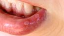صورة مقال التهاب الشفاه من الخارج
