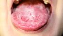 صورة مقال ما سبب تقرحات اللسان
