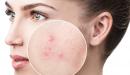 صورة مقال كيفية علاج آثار حب الشباب طبيعياً