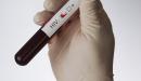 صورة مقال ما هو تحليل HIV