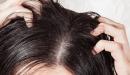 صورة مقال طريقة التخلص من قشرة الشعر