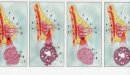 صورة مقال مراحل تطور سرطان الثدي