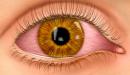 صورة مقال حول العين المفاجئ