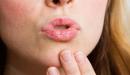 صورة مقال أسباب جفاف الشفاه