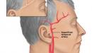 صورة مقال إلتهاب الشريان الصدغي
