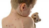 صورة مقال تشخيص مرض الحصبة