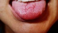 صورة مقال أسباب تشقق اللسان وعلاجه