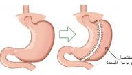 صورة مقال أضرار عملية تكميم المعدة