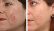 صورة مقال خلطات لإزالة آثار حب الشباب في أسرع وقت
