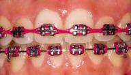 صورة مقال أنواع تقويم الأسنان وأفضلها