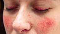 صورة مقال ظهور بقع حمراء على الجلد بدون حكة
