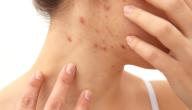 صورة مقال علاج حب الشباب للبشرة الدهنية الحساسة