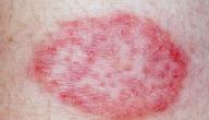 فطريات الجلد الحمراء