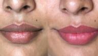 صورة مقال وصفة لإزالة سواد الشفاه
