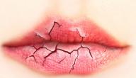 صورة مقال وصفات لعلاج تشقق الشفاه