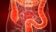 صورة مقال متلازمة تهيج الأمعاء الغليظة