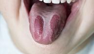 صورة مقال ما علاج فطريات اللسان