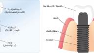 صورة مقال مراحل زراعة الأسنان
