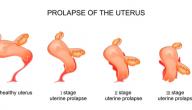 صورة مقال كيف أعرف هبوط الرحم