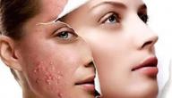 صورة مقال كيف أزيل آثار حب الشباب بسرعة