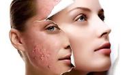 صورة مقال التخلص من آثار حب الشباب الحمراء