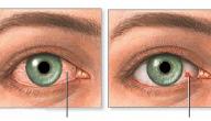 صورة مقال ما سبب اصفرار العين