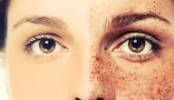 صورة مقال وصفات لعلاج الكلف والنمش