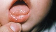 صورة مقال فطريات الفم عند الرضع أسبابها وعلاجها