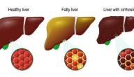 صورة مقال ما هو علاج تليف الكبد