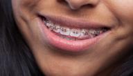 صورة مقال فوائد وأضرار تقويم الأسنان
