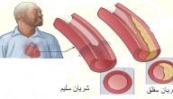صورة مقال ما هي أمراض القلب