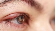 صورة مقال علاج التهاب حول العين
