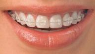 صورة مقال عيوب التقويم الشفاف للأسنان
