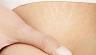 صورة مقال أسباب ظهور علامات تمدد الجلد