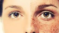 صورة مقال سبب ظهور بقع بنية على الوجه