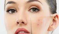 صورة مقال طرق تبييض الوجه وإزالة حب الشباب