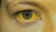 صورة مقال ما هي أسباب اصفرار العين - فيديو